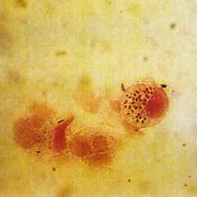 Lichtmikroskopische Aufnahme von Tripper-Erregern (Bakterium Neisseria gonorrhoeae) – Kugelbakterien (Kokken) 